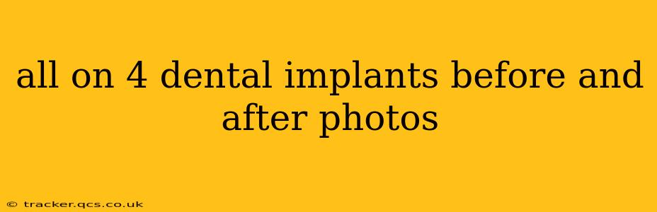 all on 4 dental implants before and after photos