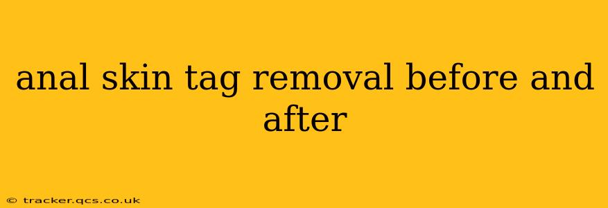 anal skin tag removal before and after