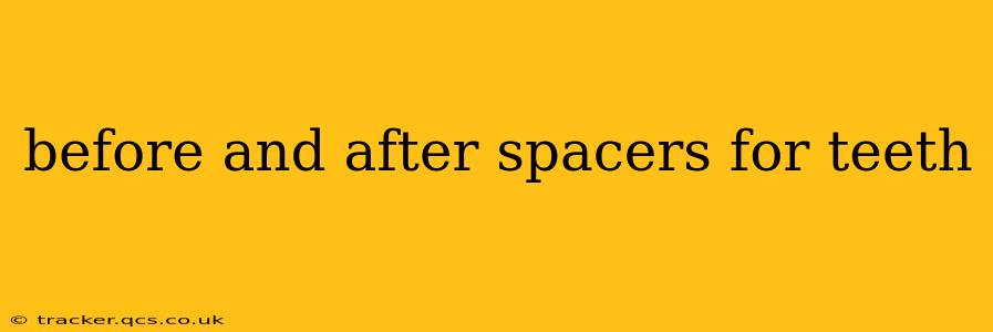 before and after spacers for teeth
