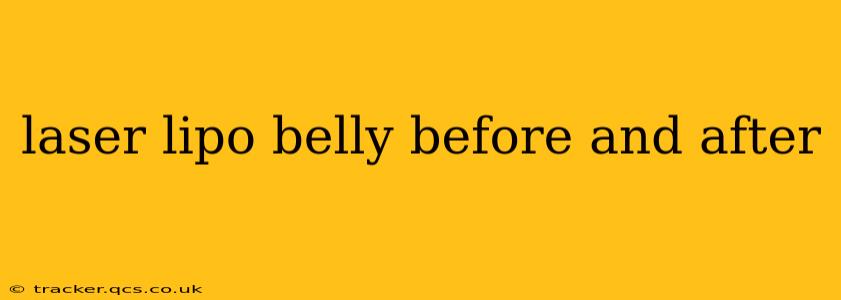 laser lipo belly before and after