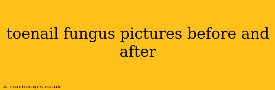 toenail fungus pictures before and after