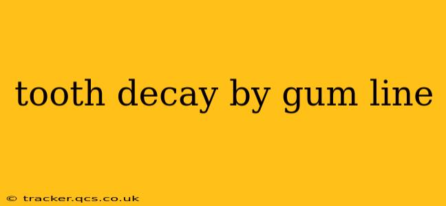 tooth decay by gum line